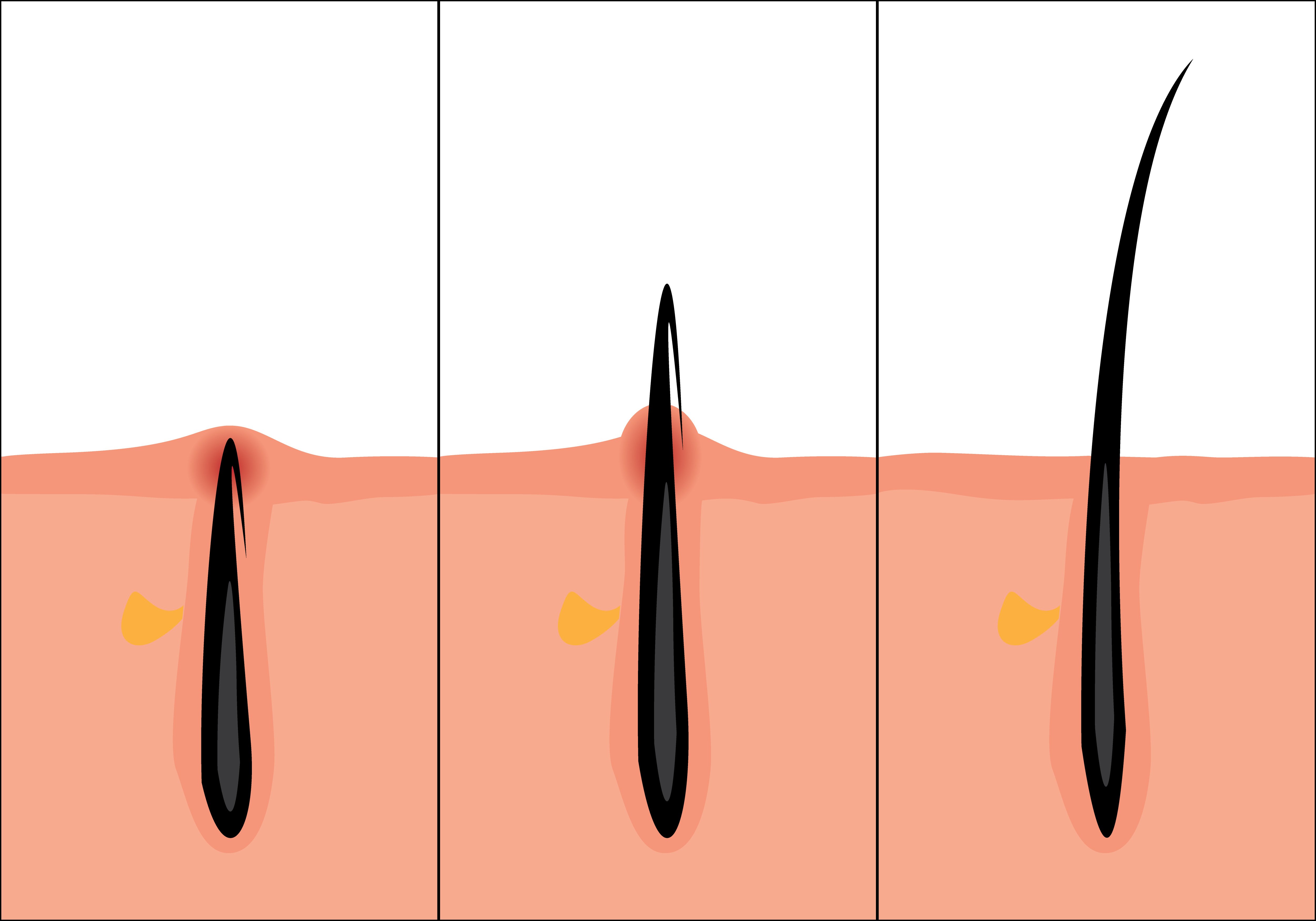 Eingewachsenes Haar versus normales Haar